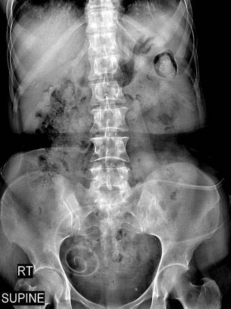 Renal replacement therapy | Radiology Reference Article | Radiopaedia.org