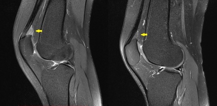 Fat pad impingement syndromes of the knee | Radiology Reference Article ...