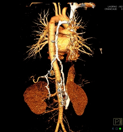 Azygos and hemiazygos veins | Radiology Case | Radiopaedia.org