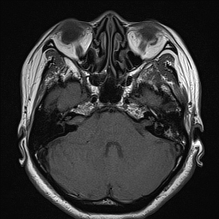 Cerebellopontine angle meningioma | Image | Radiopaedia.org