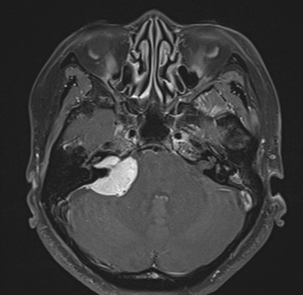 Cerebellopontine angle meningioma | Image | Radiopaedia.org