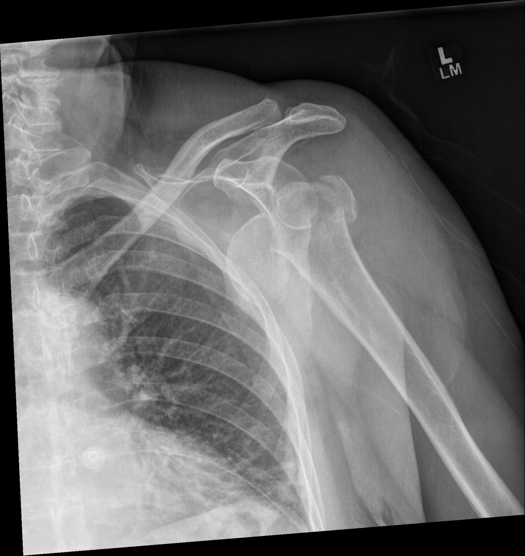 Shoulder fracture-dislocation with arterial dissection | Image