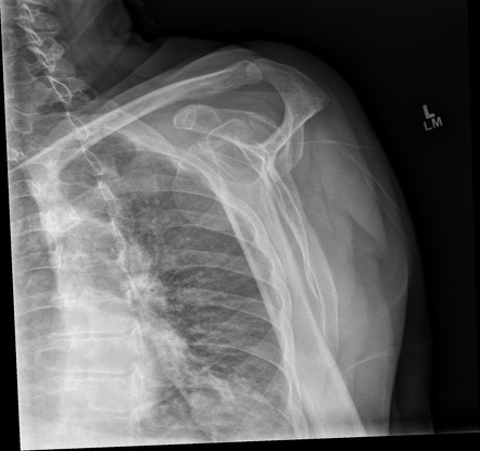 Shoulder fracture-dislocation with arterial dissection | Image ...