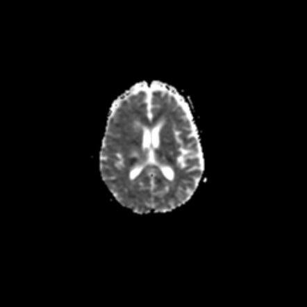 Atypical meningioma (WHO grade II) with osseous invasion | Image ...