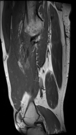 Femoral osteomyelitis with discharging sinus | Image | Radiopaedia.org