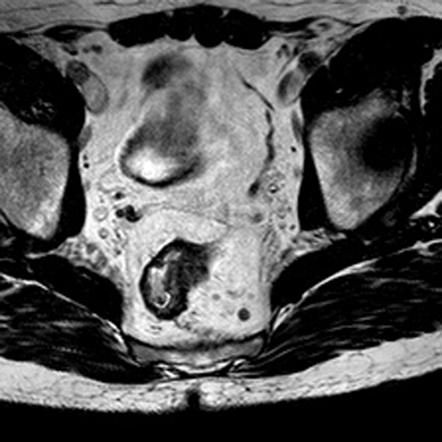 Mesorectal lymph nodes | Radiology Reference Article | Radiopaedia.org