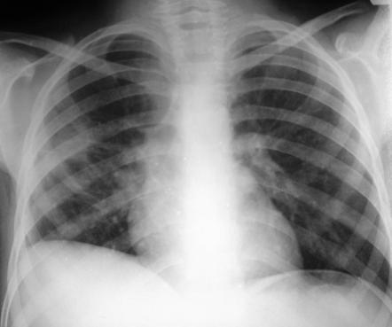 Viewing playlist: Chest Viva | Radiopaedia.org