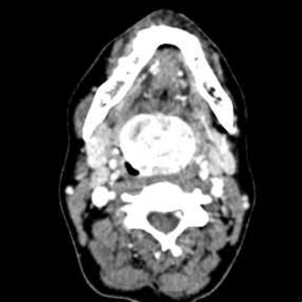 Lingual thyroid | Image | Radiopaedia.org