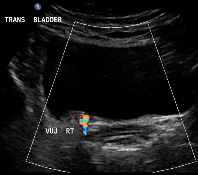 Nephrolithiasis on ultrasound with comet tail artifact | Image ...