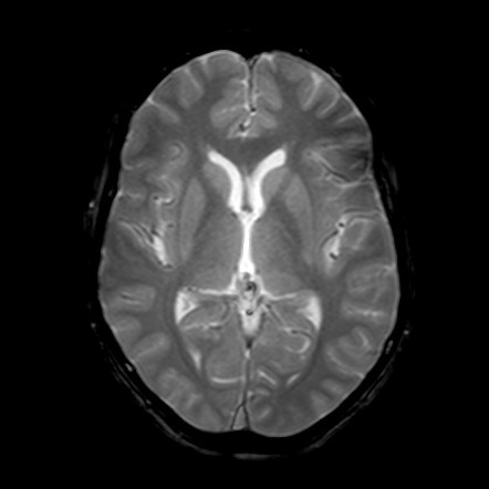 Mesial temporal sclerosis - bilateral | Image | Radiopaedia.org