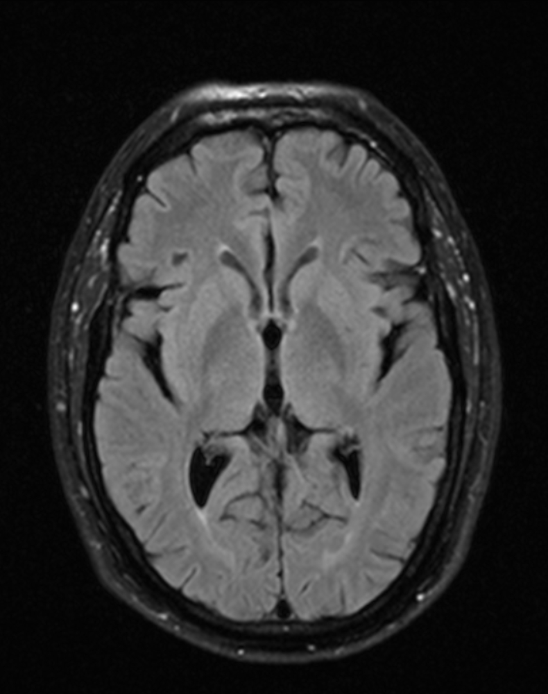 Posterior inferior cerebellar artery territory infarct - right | Image ...