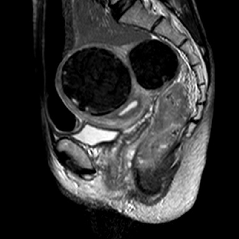 Rectal cancer (T3) and huge fibroids | Image | Radiopaedia.org