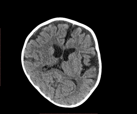 Occipital Plagiocephaly Radiology Reference Article Radiopaedia Org ...