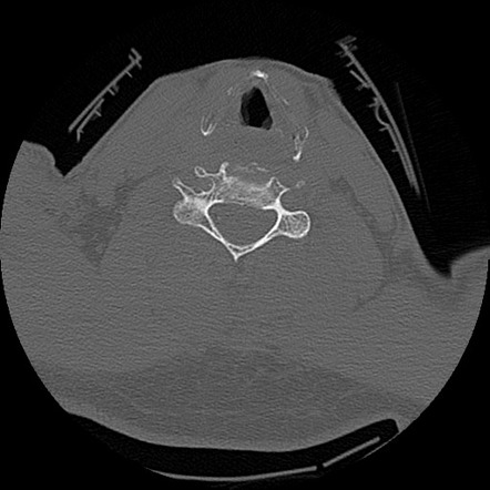 Blunt Cerebrovascular Injury Image Radiopaedia Org