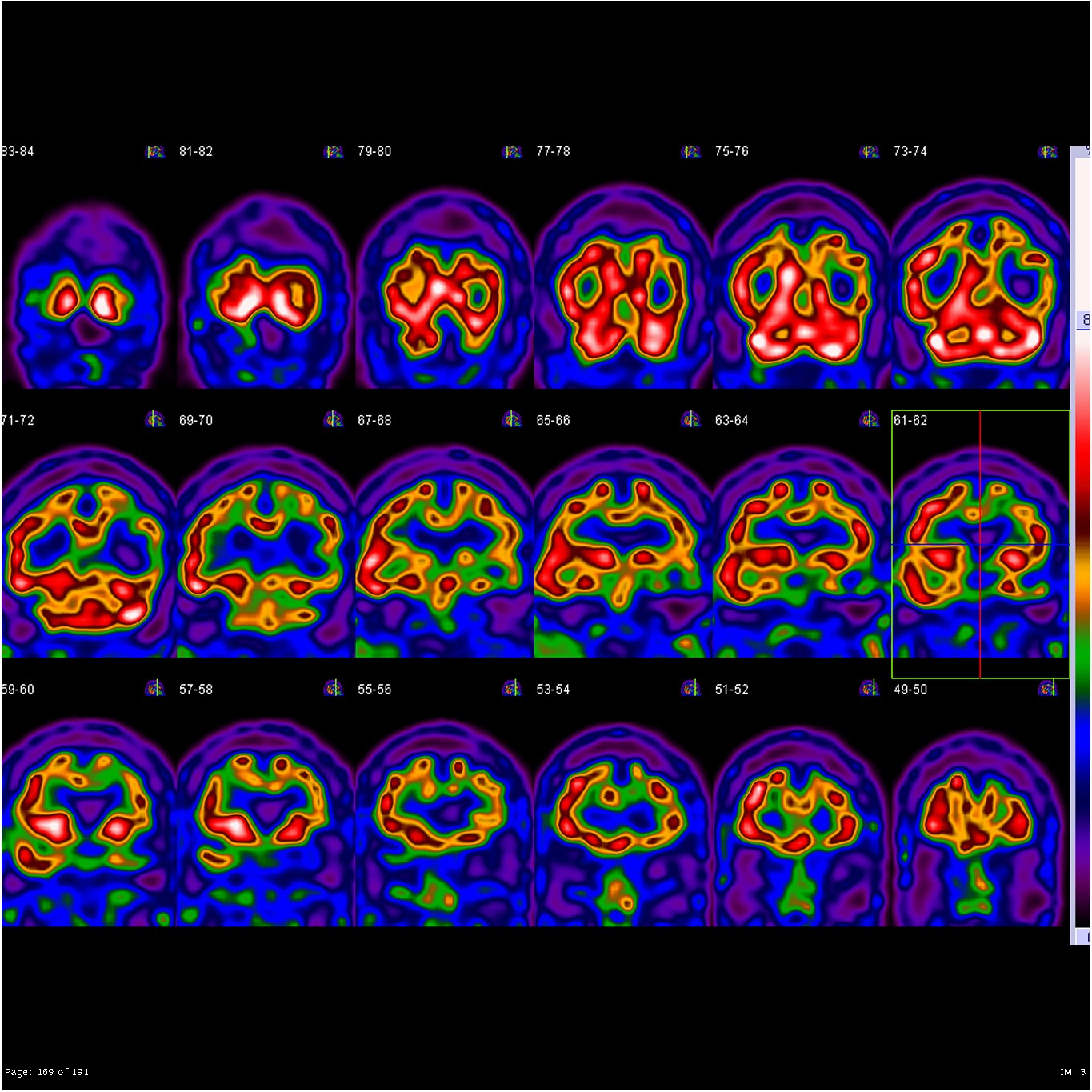 Frontotemporal dementia - semantic variant | Image | Radiopaedia.org