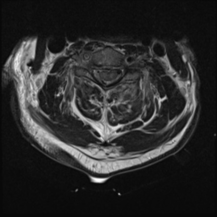 Blunt Cerebrovascular Injury Image Radiopaedia Org