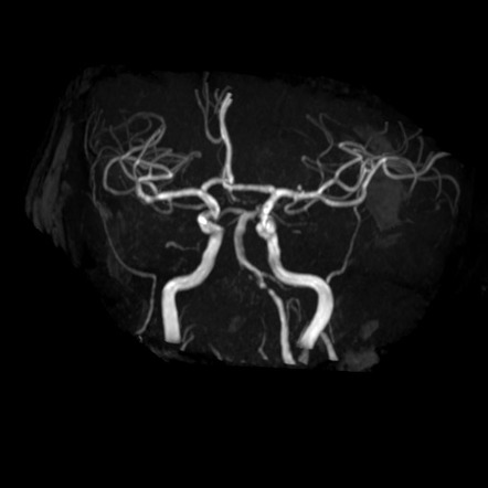 Blunt Cerebrovascular Injury Radiology Reference Article