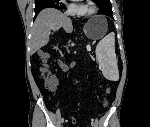 Cavernous transformation of the portal vein | Image | Radiopaedia.org