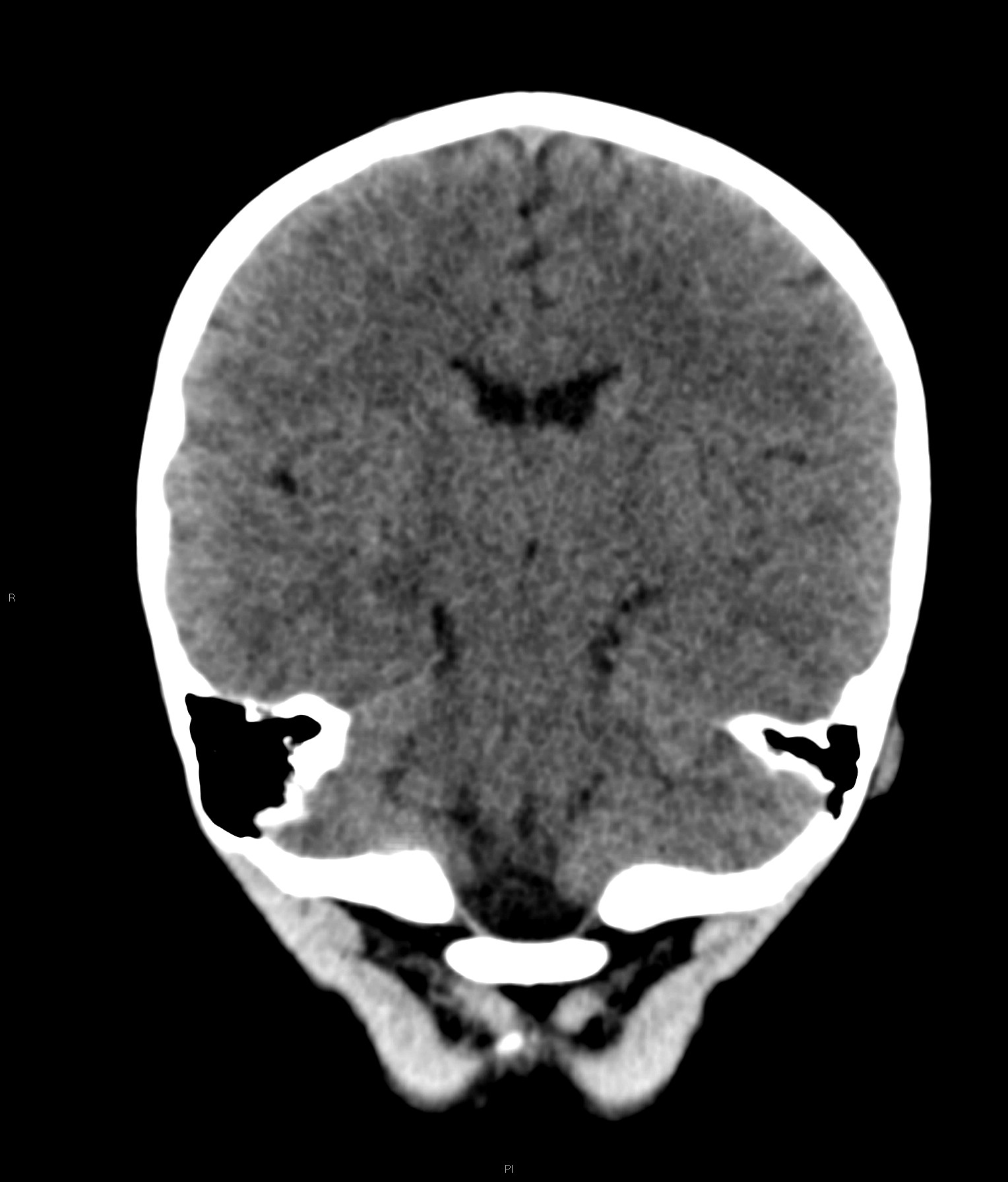 Normal CT head - 3-year-old | Image | Radiopaedia.org