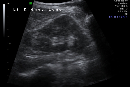 Dromedary hump of the left kidney | Radiology Case | Radiopaedia.org