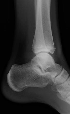 Tillaux fracture | Image | Radiopaedia.org