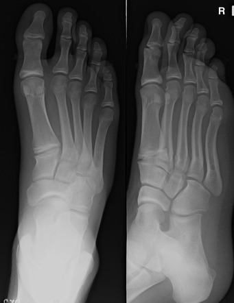 Featured image of post Bowing Fracture Tibia