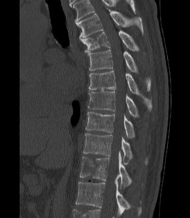 Cord compression due to osseous metastases | Radiology Case ...