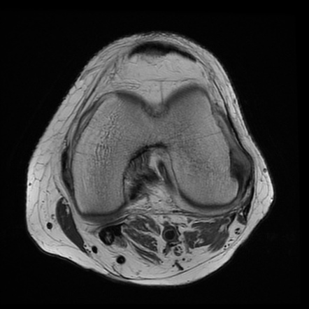 Popliteus Tendon Gout On Mri 