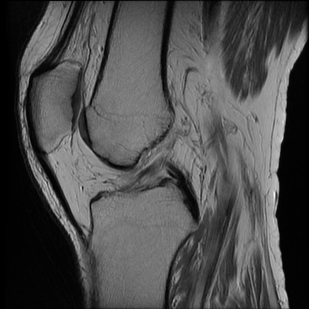 Popliteus tendon gout on MRI | Image | Radiopaedia.org