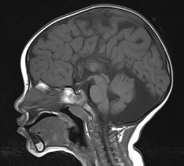 Corpus Callosum Agenesis And Hypertelorism Image