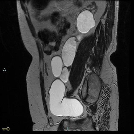 Congenital Megaureter Radiology Reference Article Radiopaedia Org