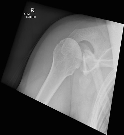 Posterior shoulder dislocation | Image | Radiopaedia.org