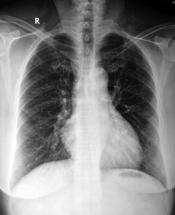 Accessory left horizontal fissure | Radiology Case | Radiopaedia.org