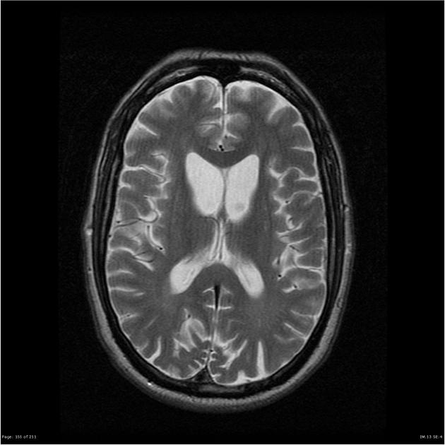 Huntington S Disease Radiology Case Radiopaedia Org