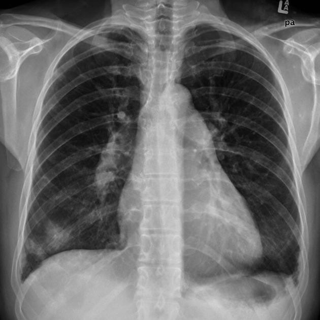 Egg and banana sign (pulmonary hypertension)