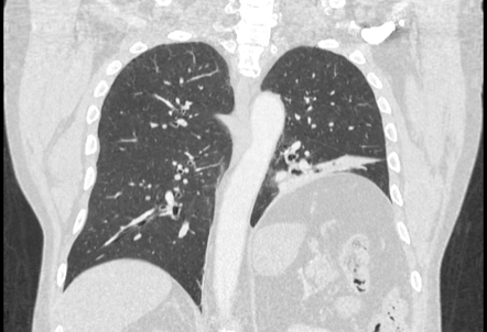 Diaphragmatic paralysis | Radiology Case | Radiopaedia.org