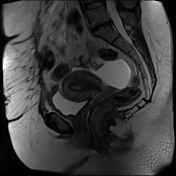 Peritoneal inclusion cyst | Radiology Reference Article | Radiopaedia.org