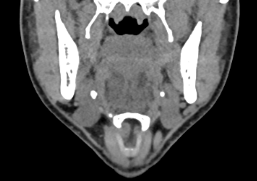 Submandibular Sialolithiasis Image