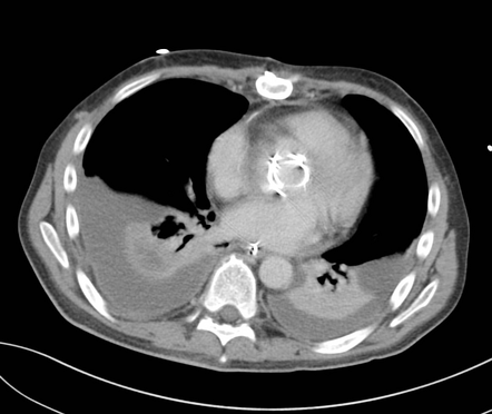 Multiple emboli from aortic valve replacement | Radiology Case ...