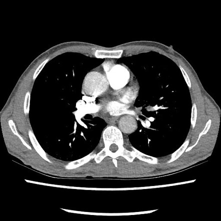 Accessory left horizontal fissure with lingular pneumonia | Image ...