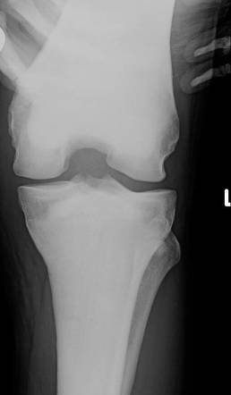 Osteopetrosis | Radiology Case | Radiopaedia.org