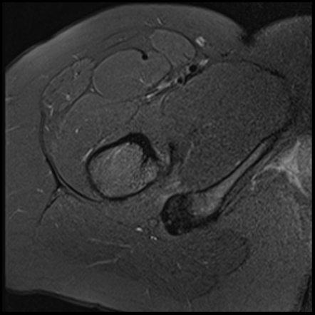 Ischiofemoral impingement | Radiology Reference Article | Radiopaedia.org