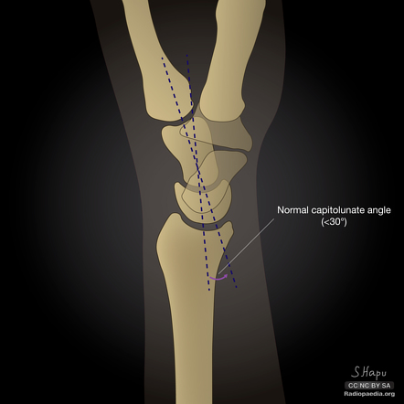 Capitolunate angle | Radiology Reference Article | Radiopaedia.org