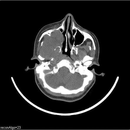 Carcinoma Of The Maxillary Antrum Image Radiopaedia Org