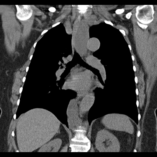 Lymphocele of the thoracic duct | Image | Radiopaedia.org