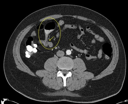 Meckel diverticulum | Radiology Reference Article | Radiopaedia.org