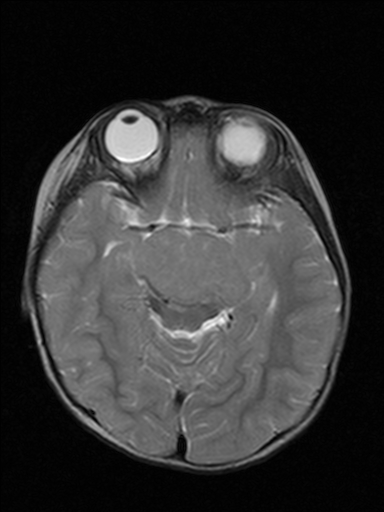 Pallister-Hall syndrome | Image | Radiopaedia.org