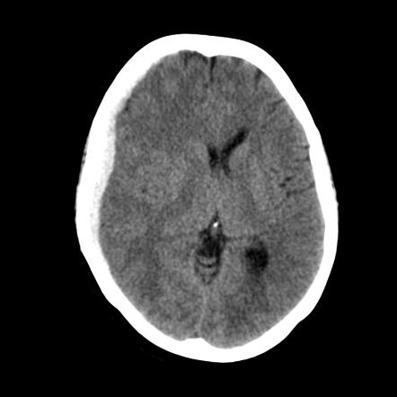 Subdural Hematoma Radiology Case Radiopaedia Org