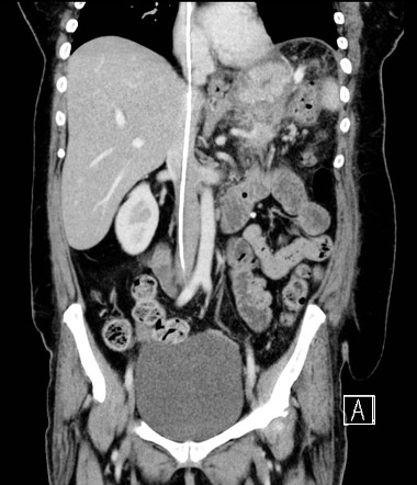 Caval misplaced wire | Image | Radiopaedia.org