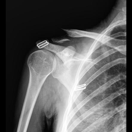 Clavicular Fracture 